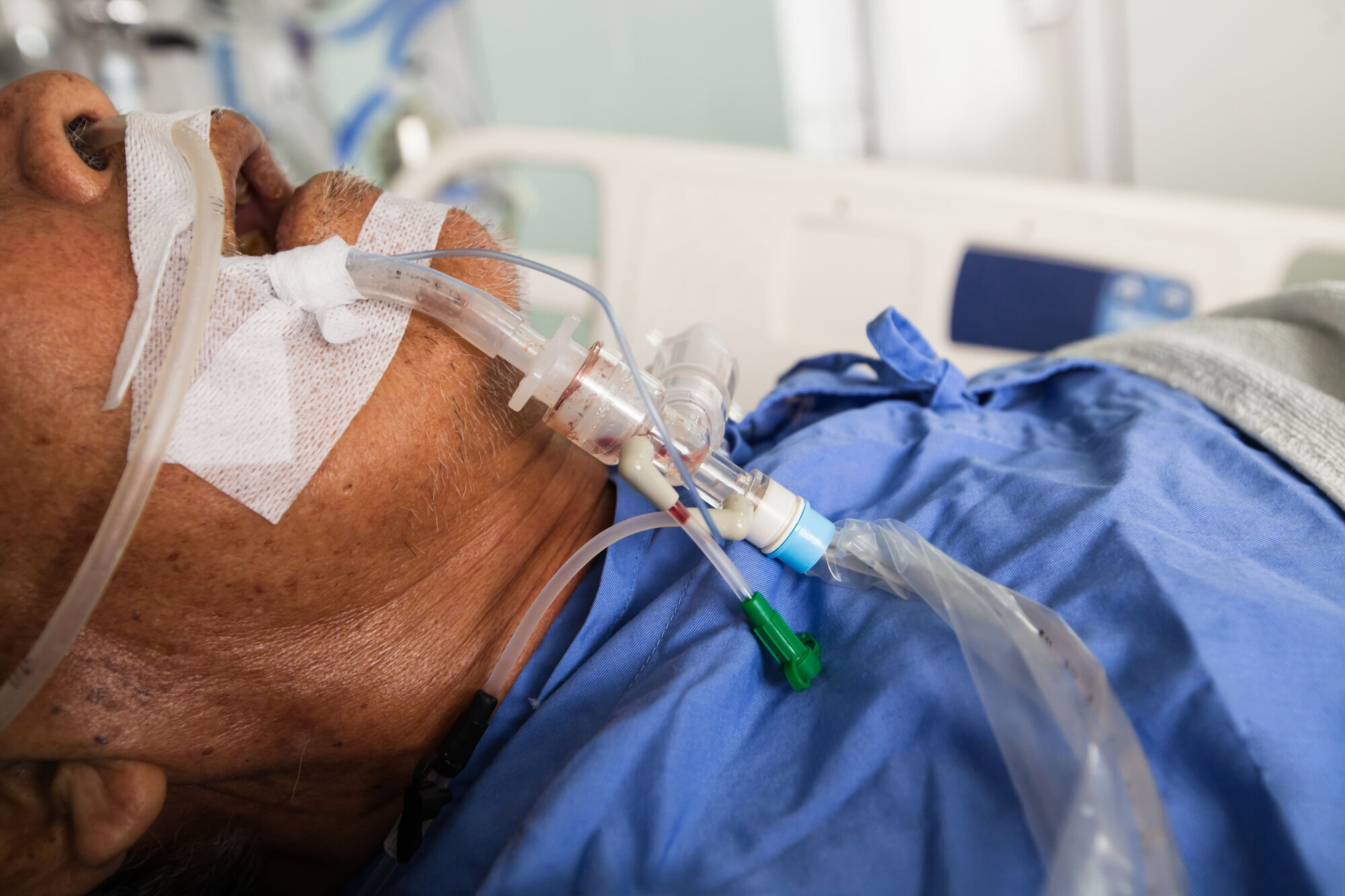 Bildet viser en respiratorpasient med en endotrakealtube via munn. Bildet viser en respiratorpasient med en endotrakealtube via munn.