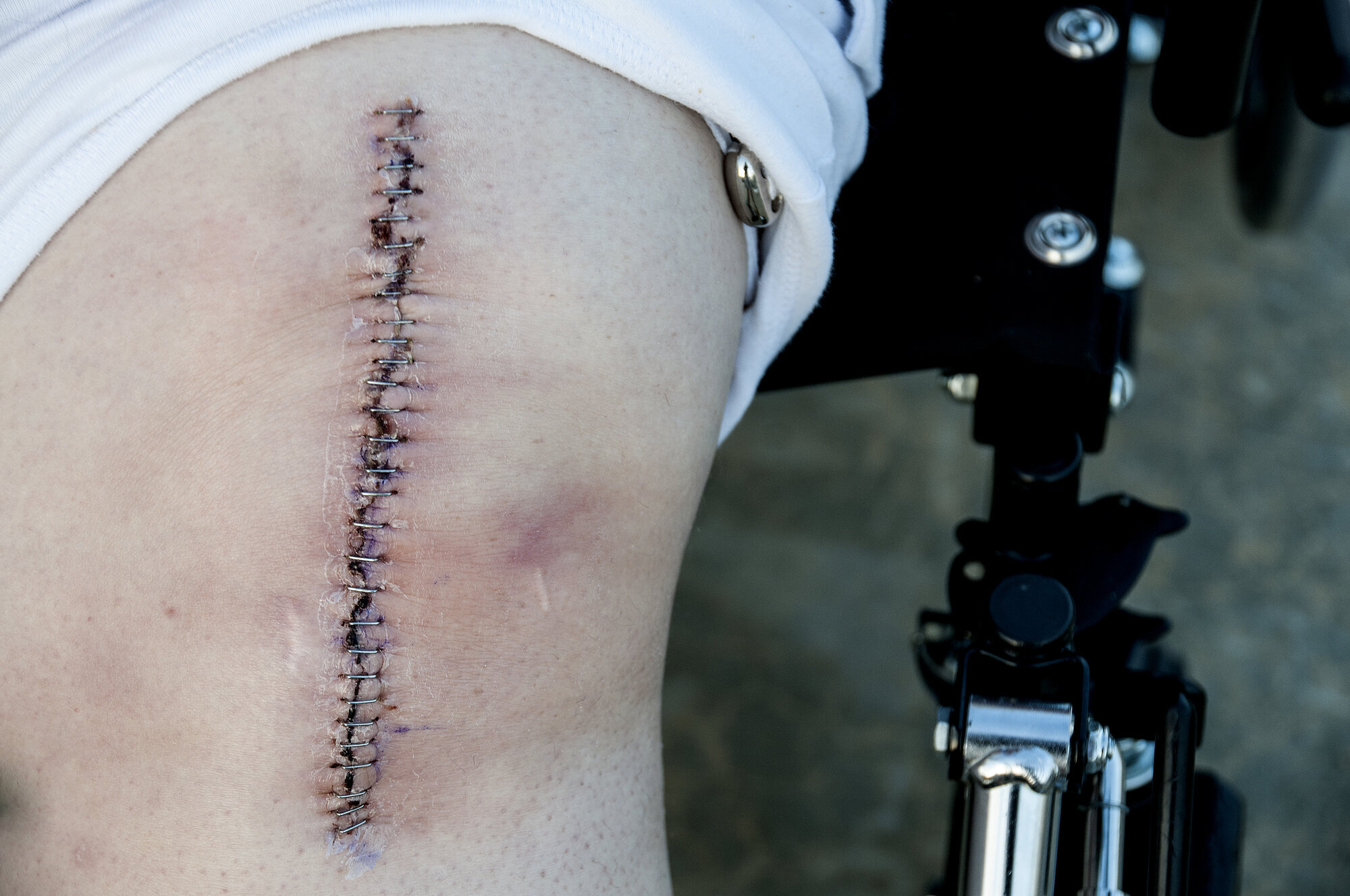 Total kneprotese, operasjon, smerter Bildet viser et kne med et stort, loddrett arr etter en total kneoperasjon (total kneprotese).