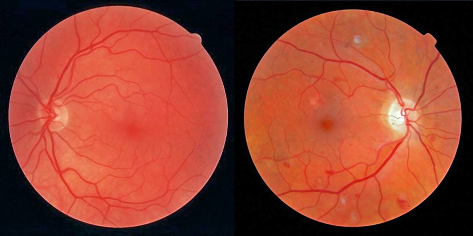 netthinne, diabetes Bildet viser to netthinner.