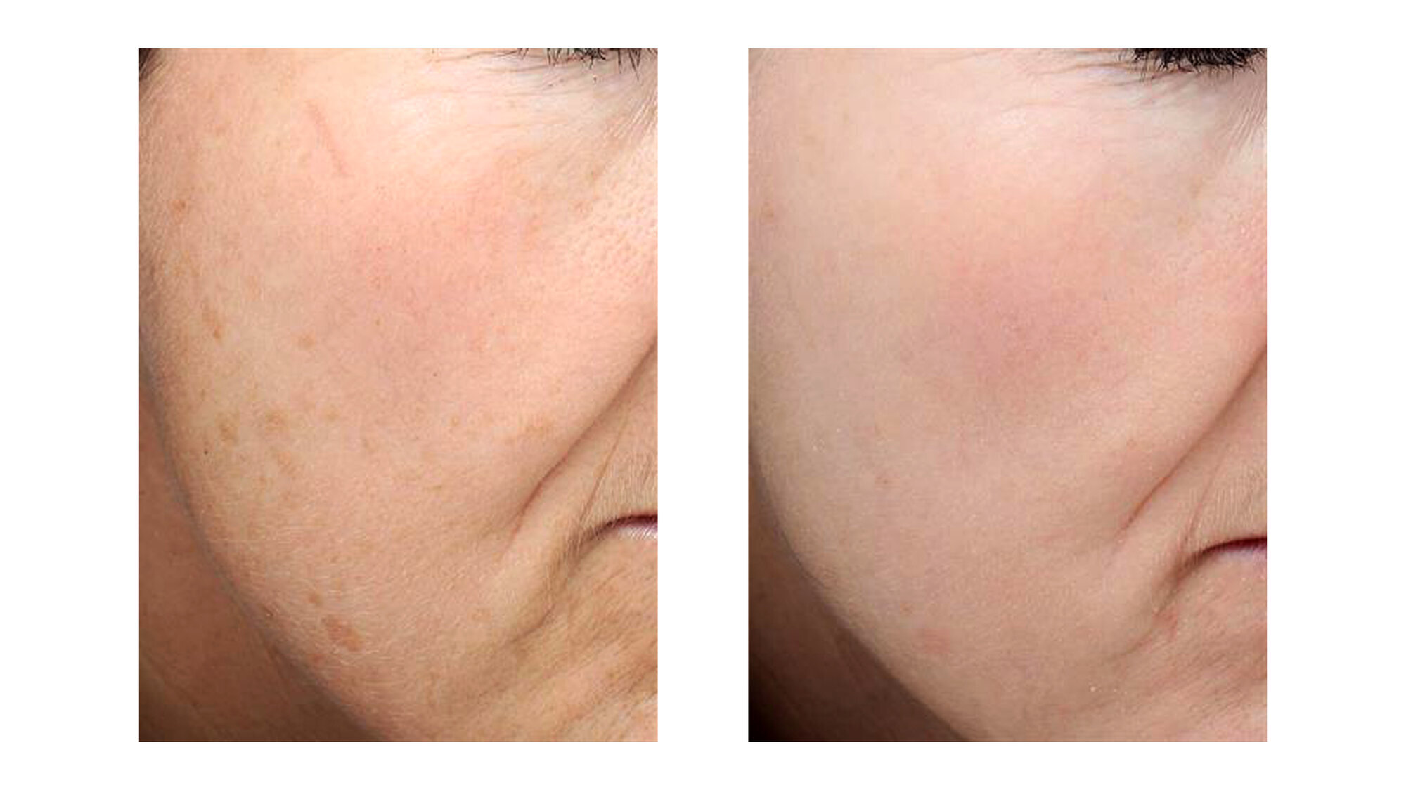 Bildet viser før-og-etter-bilder av en pasient som har fått behandling for arr etter vannkopper Før-og-etter-bilder