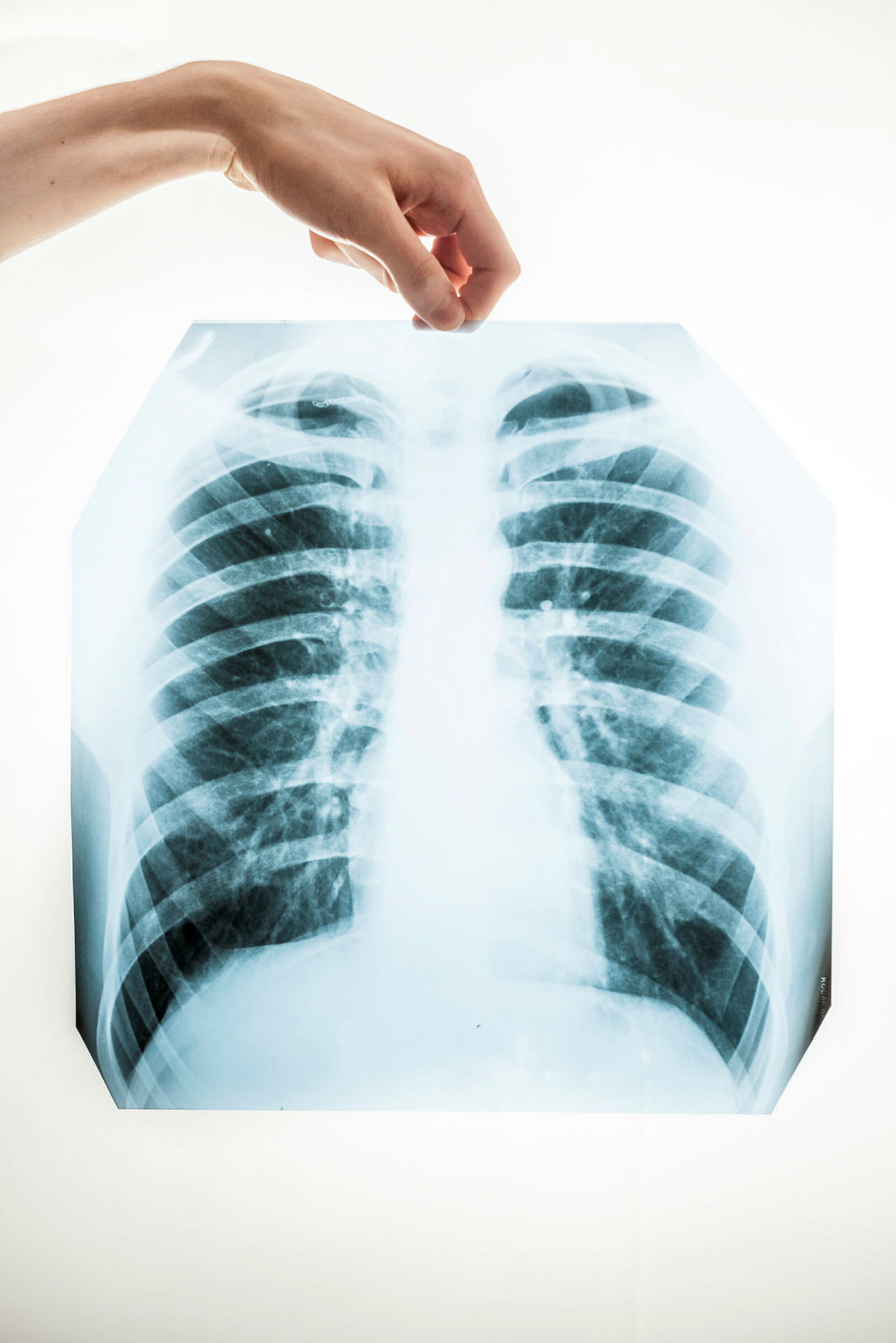 Røntgenbilde av lunger