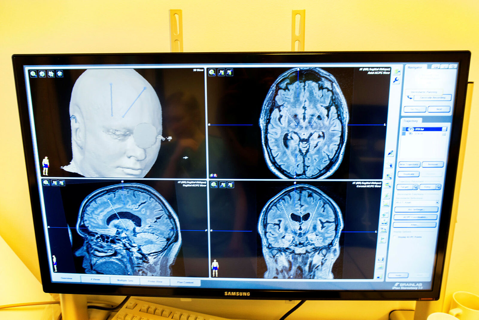 ct-bilde CT-bilde av pasient med Parkinsons sykdom