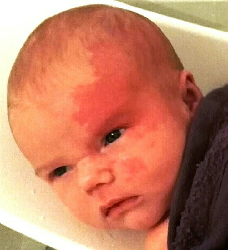 FØDSELSMERKE: Barn med rødlige flekker i huden, såkalte «portvinsflekker». Barn med rødlige flekker i huden, såkalte «portvinsflekker», som er en type fødselsmerke.