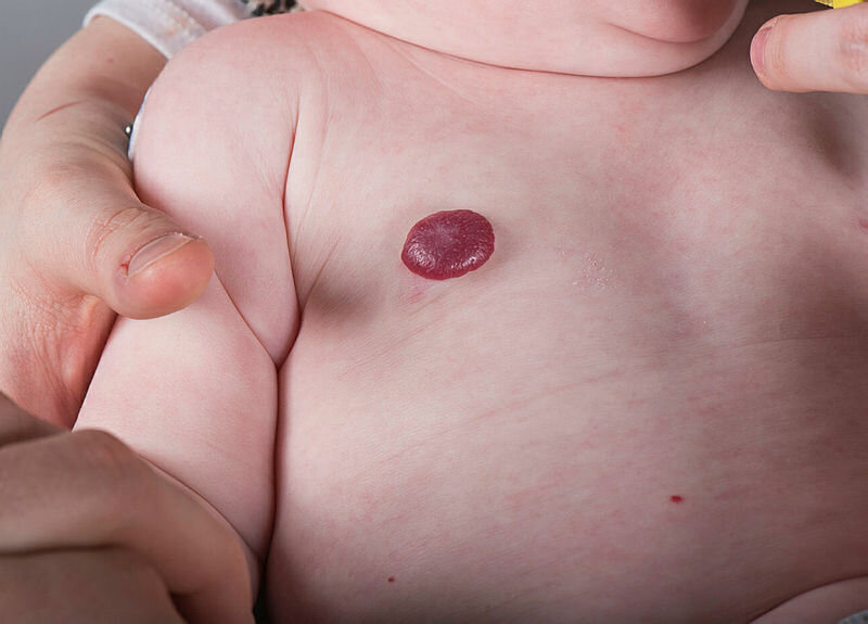 Hemangiom Bilde av hemangiom som av utseende kan minne om et jordbær.