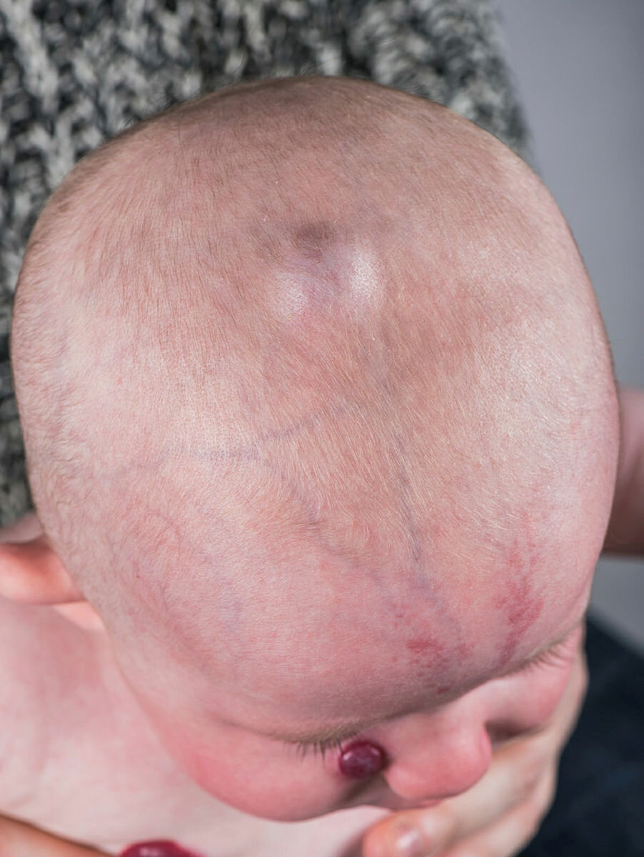 Hemangiom av dypereliggende type. Hemangiom av dypereliggende type.