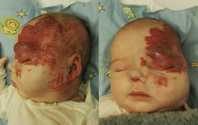 Hemangiom rundt øyet Hemangiom rundt øyet