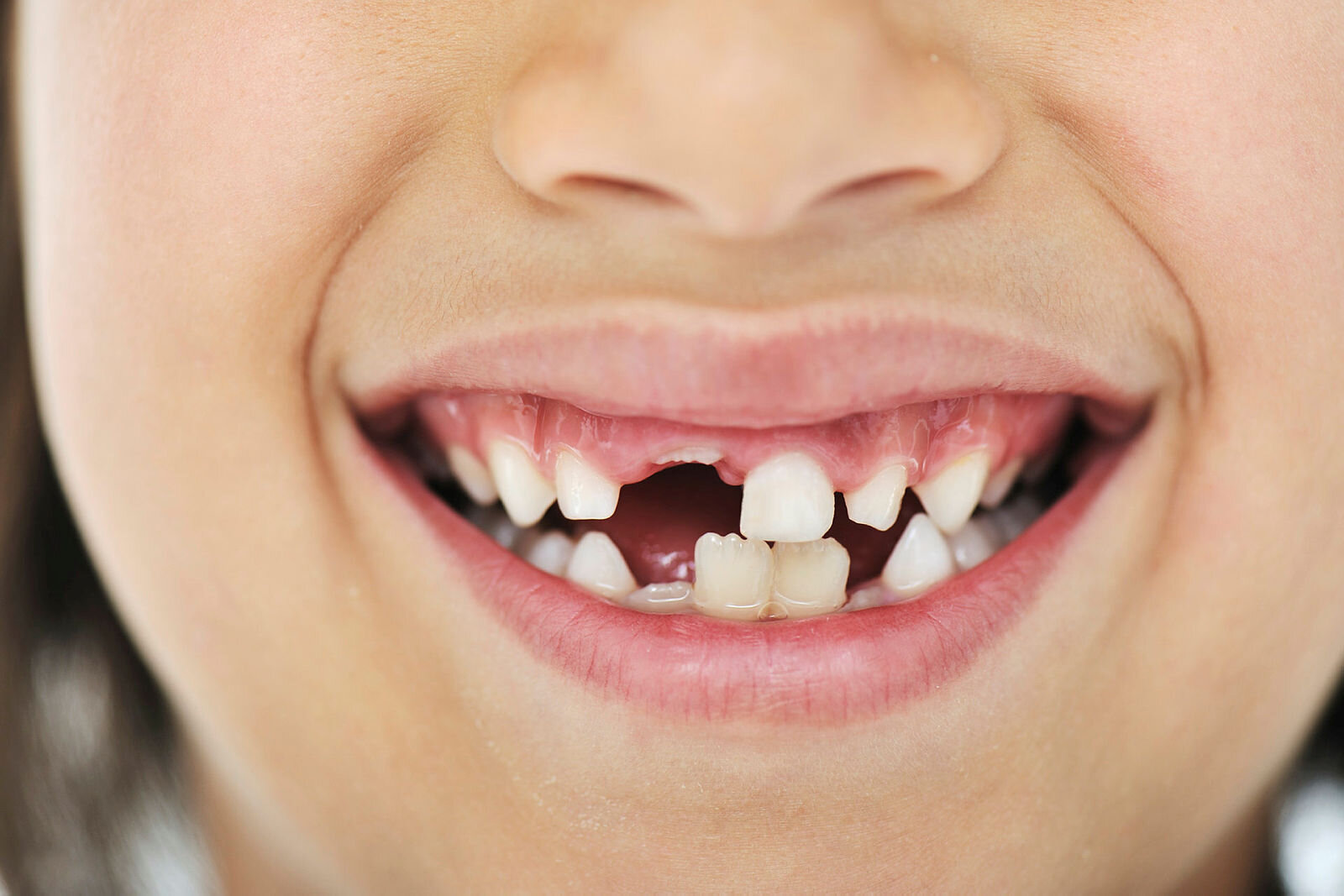 Tannfelling Bildet viser tanngarden til en ung gutt eller jente som har mistet noen av fortennene.