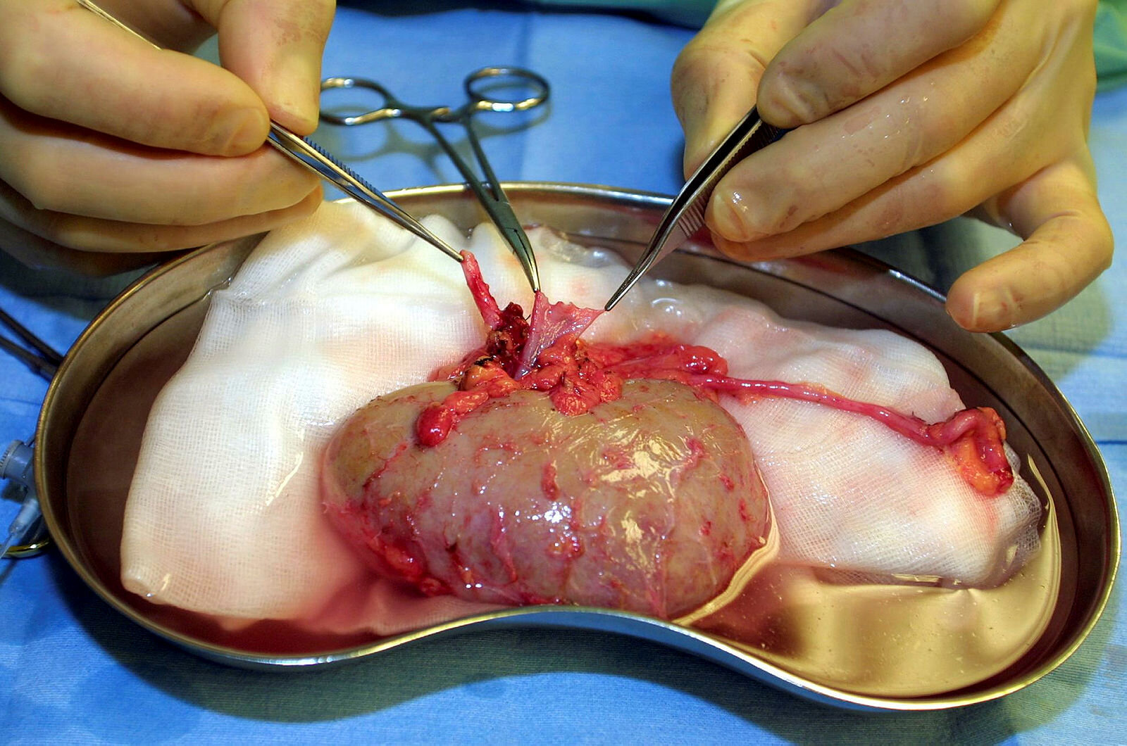 Nyretransplantasjon Bildet viser en nyre som er blitt operert ut av en mann. Nyren ligger på et fat, og to hender med instrumenter og saks arbeider.