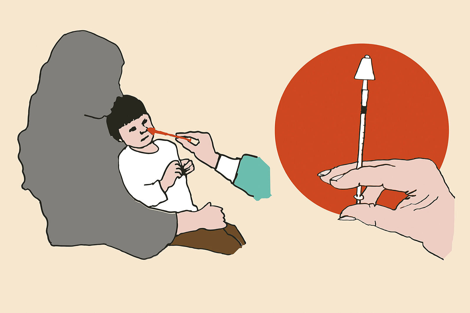 Barn som sederes med nesespray Illustrasjonen viser et barn som sederes med nesespray – intranasal deksmedetomidin – før anestesi. Til høyre ses sprøyten som brukes til administrering av medikamentet.