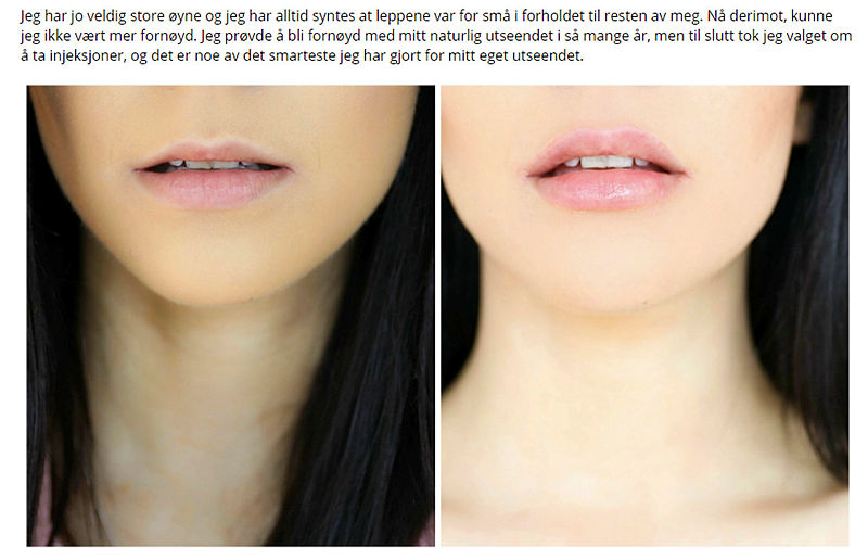 Bildet viser før-og-etter-bilder av bloggeren Stina Marie Bakken, som har tatt Restylane i leppene.