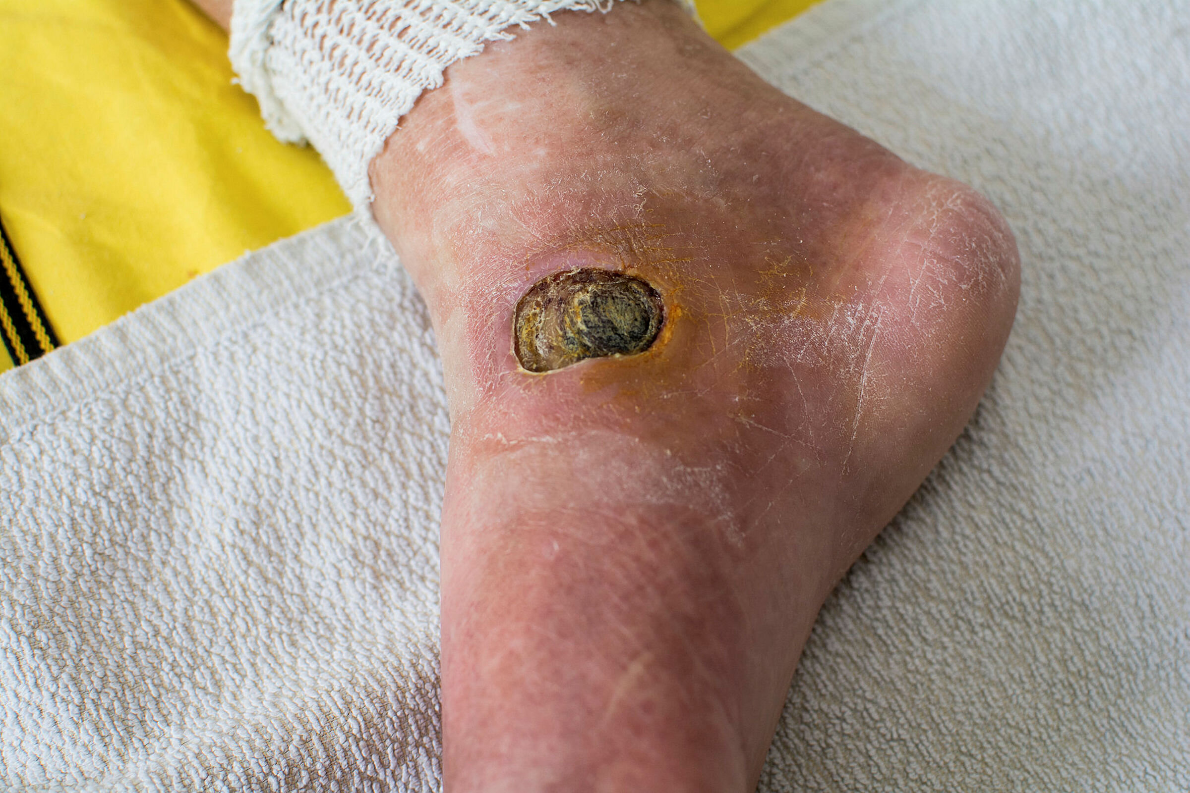 Diabetessår Bildet viser en fot med et stygt diabetessår ved siden av ankelen på innsiden av foten.