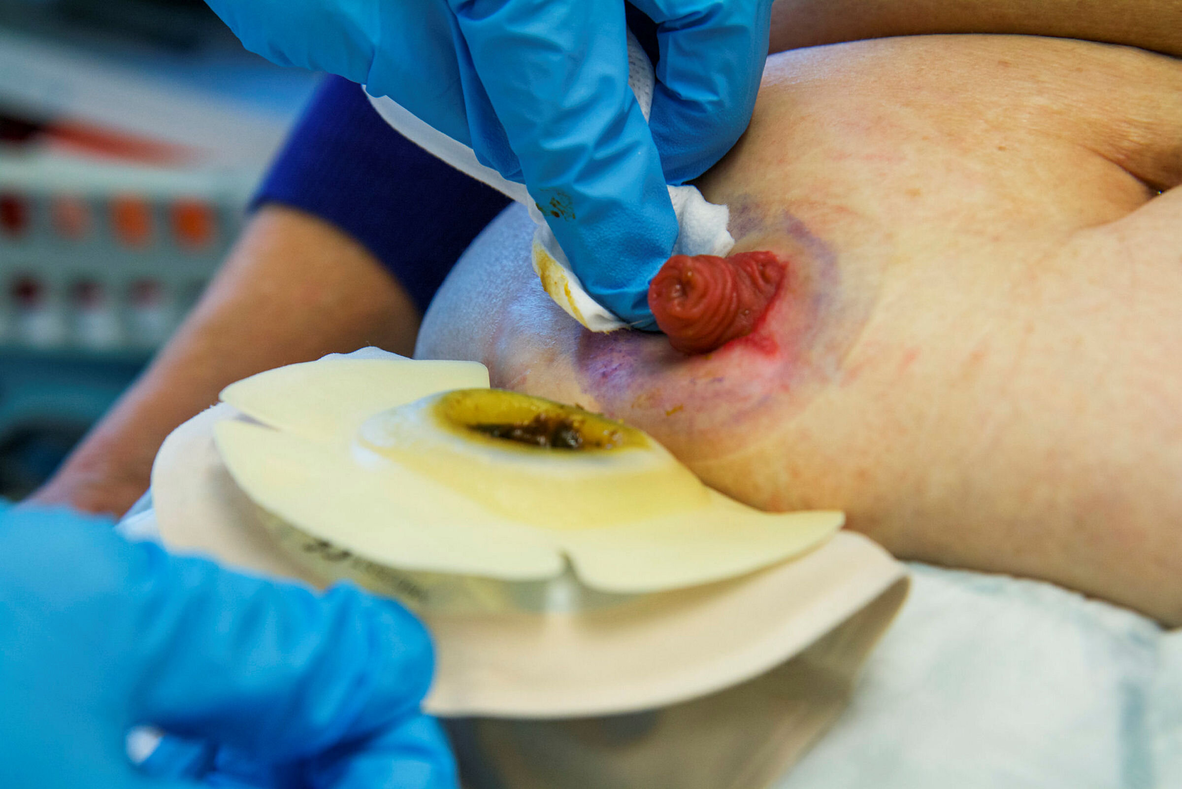 Grethe Følstad Lund og Villa Wahl Stranger Stomisykepleier Grethe Følstad Lund og Villa Wahl Stranger, Radiumhospitalet