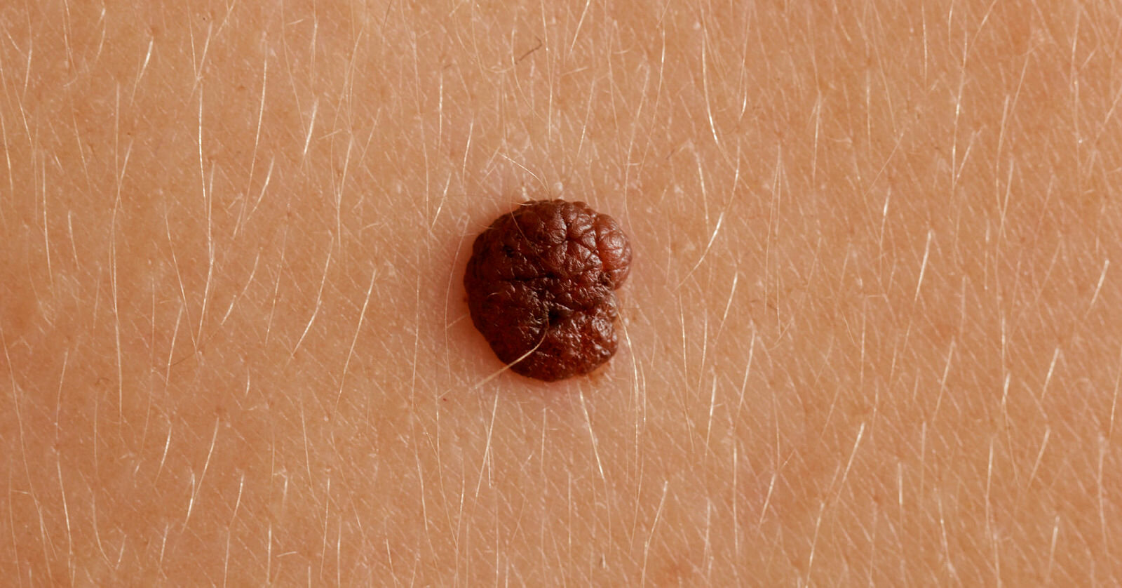 Føflekkreft Nærbilde av føflekk
