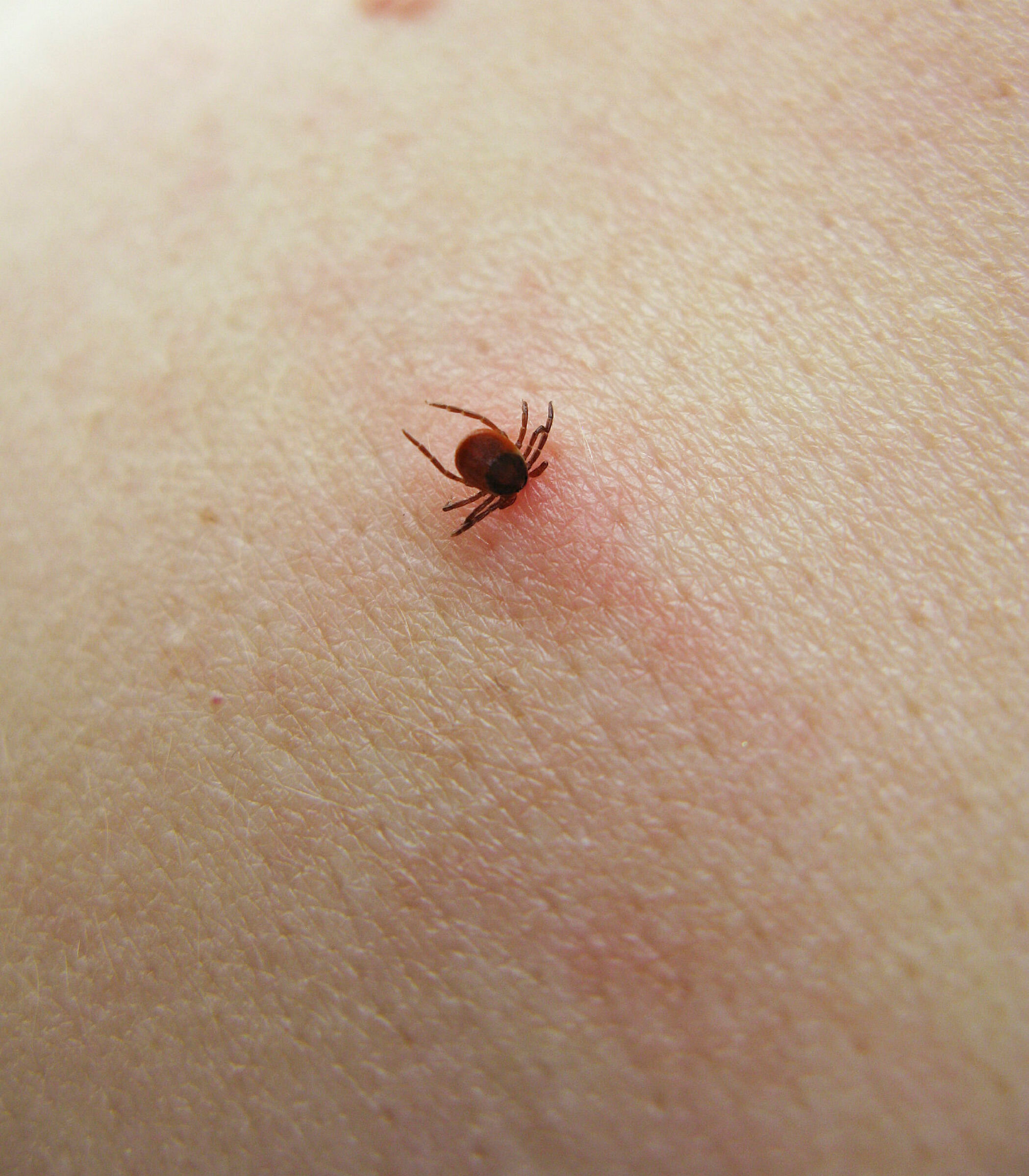 Tick sucking on skin Flått som sitter på hud.
