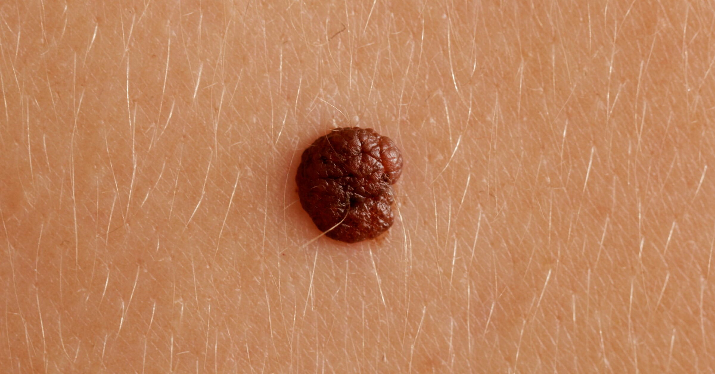 Føflekkreft Nærbilde av føflekk