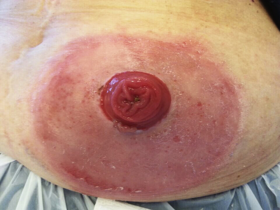 Psoriasis stomi Psoriasis stomi