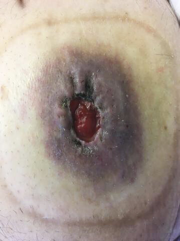 Urin på huden ved urostomi Urin på huden ved urostomi