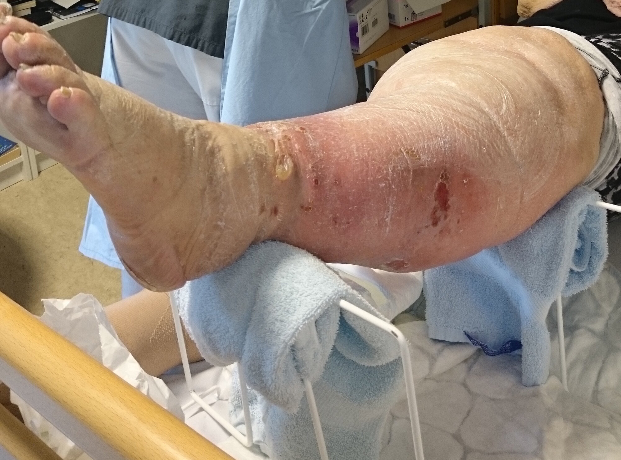 Multipuff, sårstell. Multipuff har to støtter som kan flyttes under beinet, slik at man kommer til alle steder på beinet.