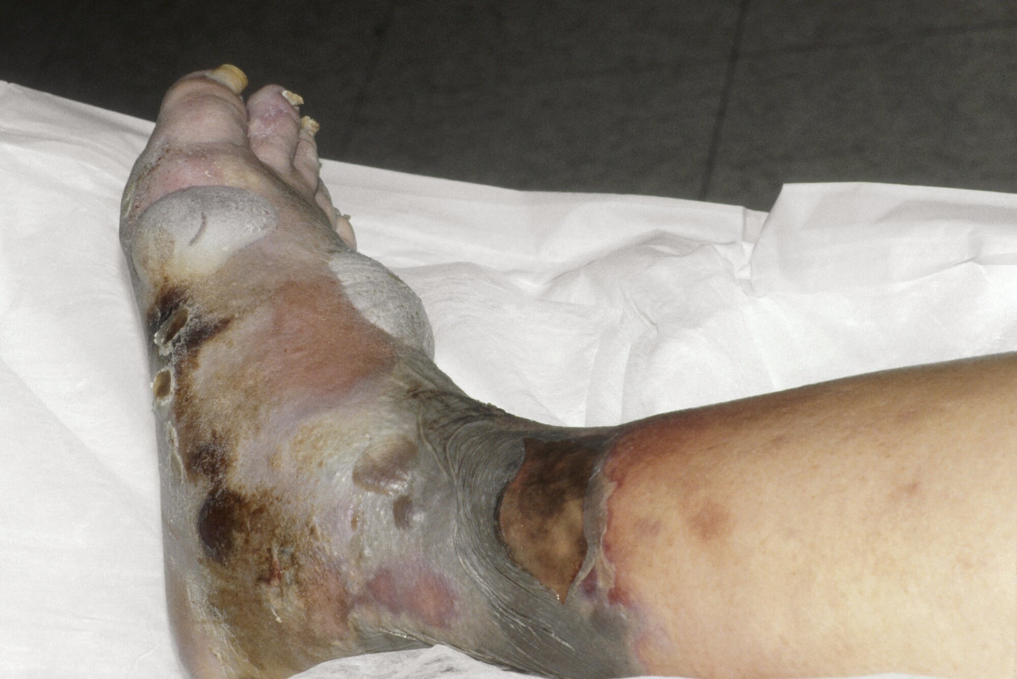 Nekrotiserende fasciitt Kjøttetende bakterie i foten til diabetespasient