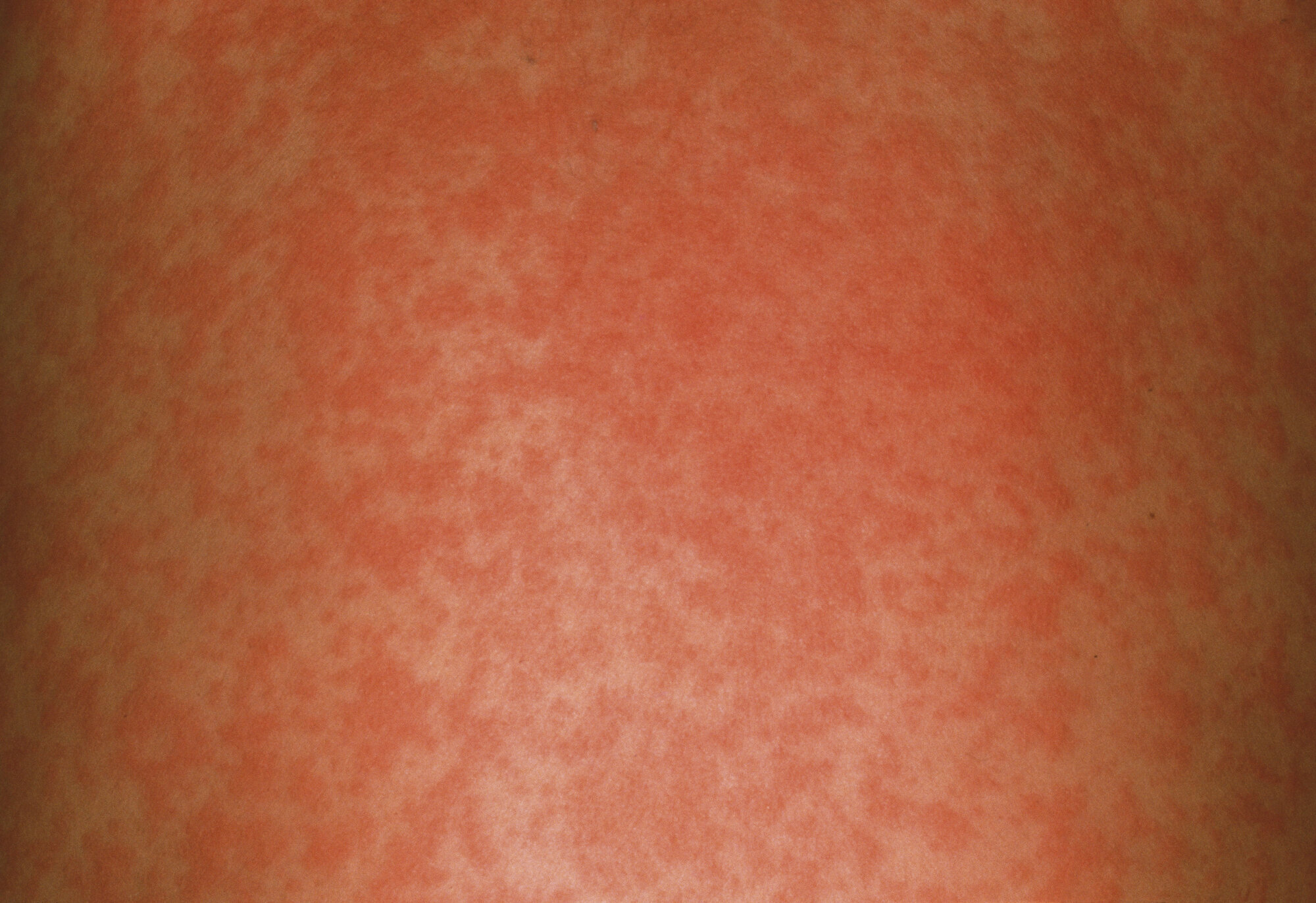 Bilde av ryggen til et barn som har meslinger Bilde av ryggen til et barn som har meslinger