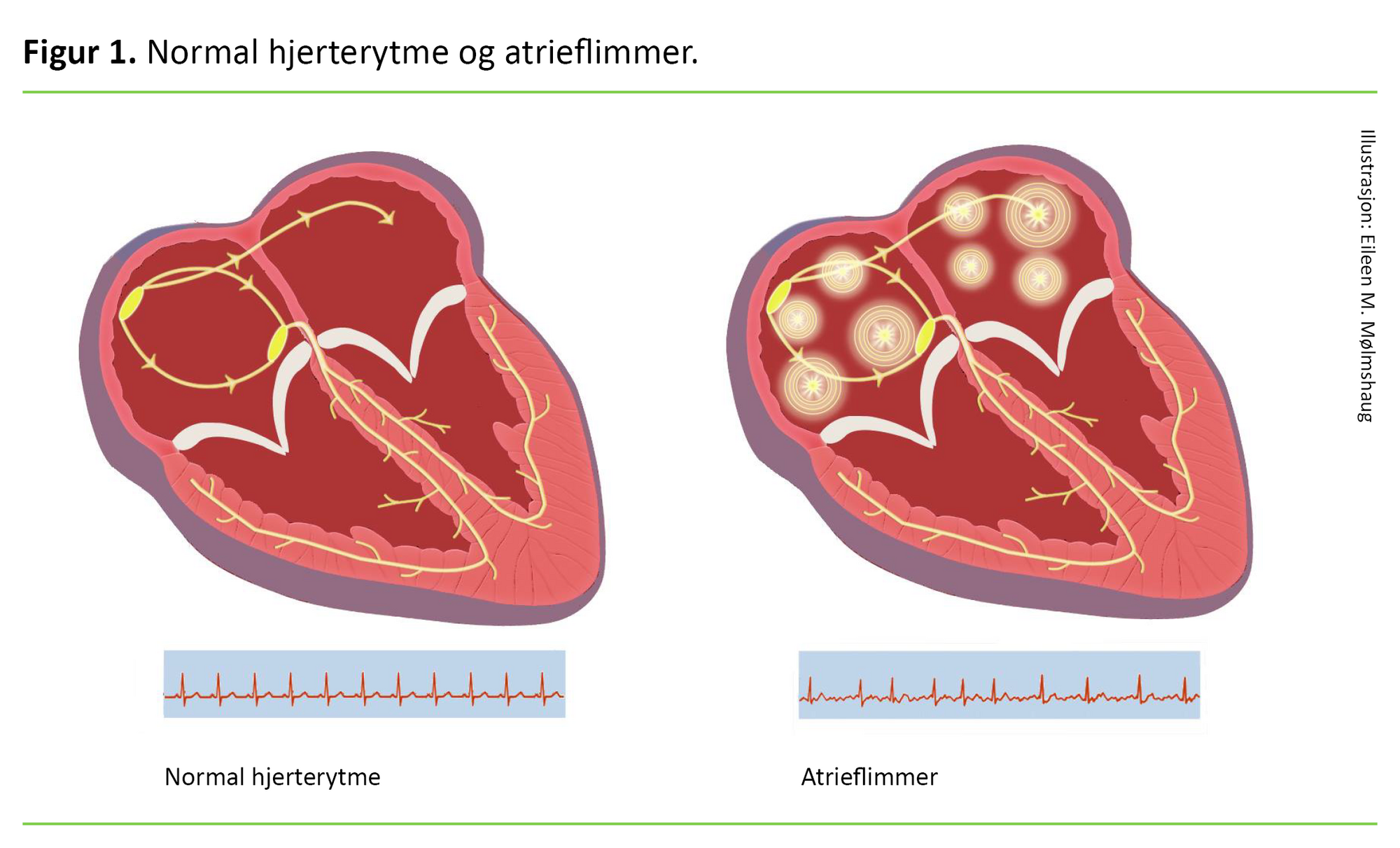 Figur 1 Figur 1. Tegning av to hjerter. Det ene med normal hjerterytme, det andre med atrieflimmer.