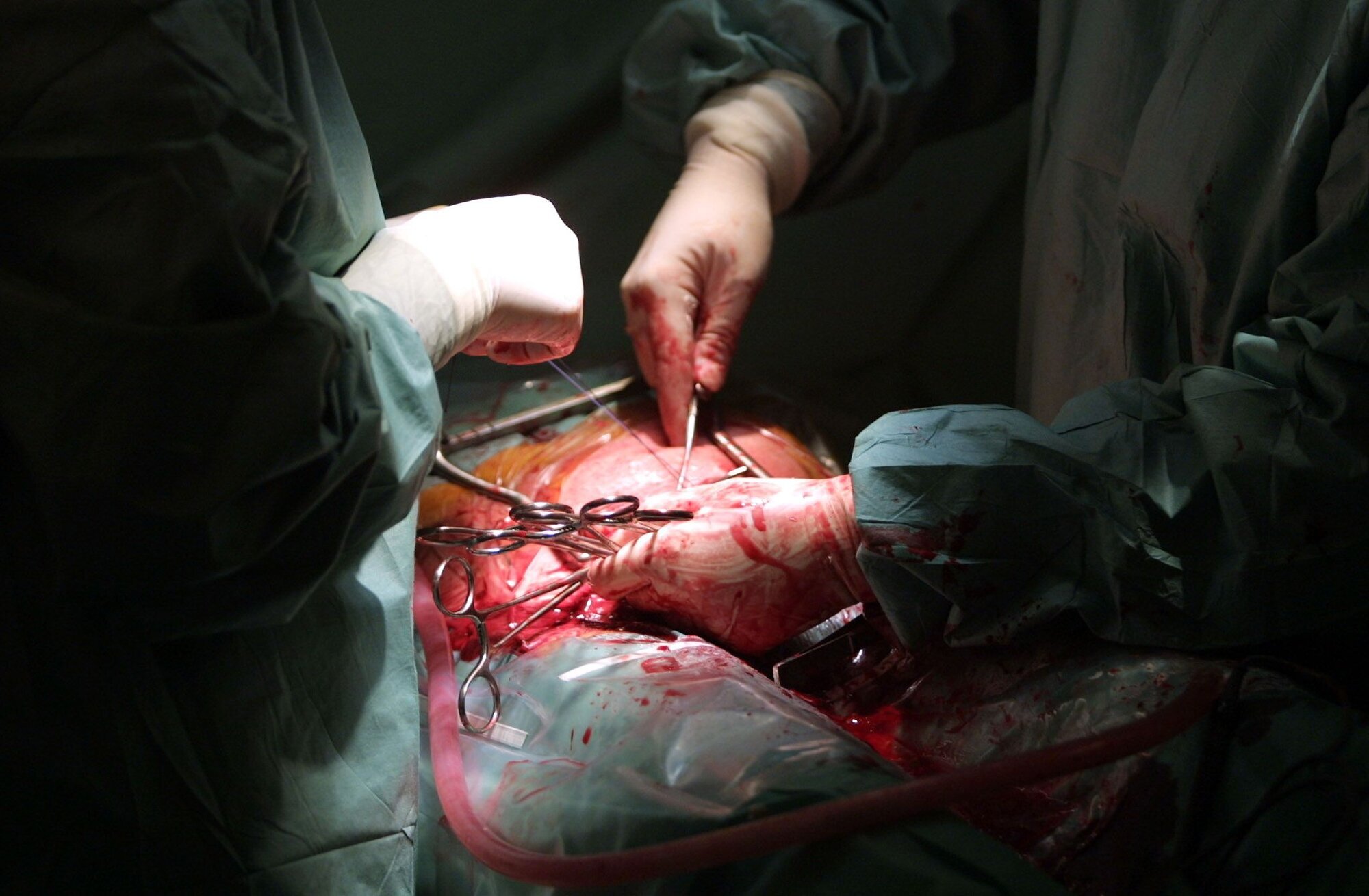 Operasjon Nærbilde av helsepersonell som gjennomfører en operasjon