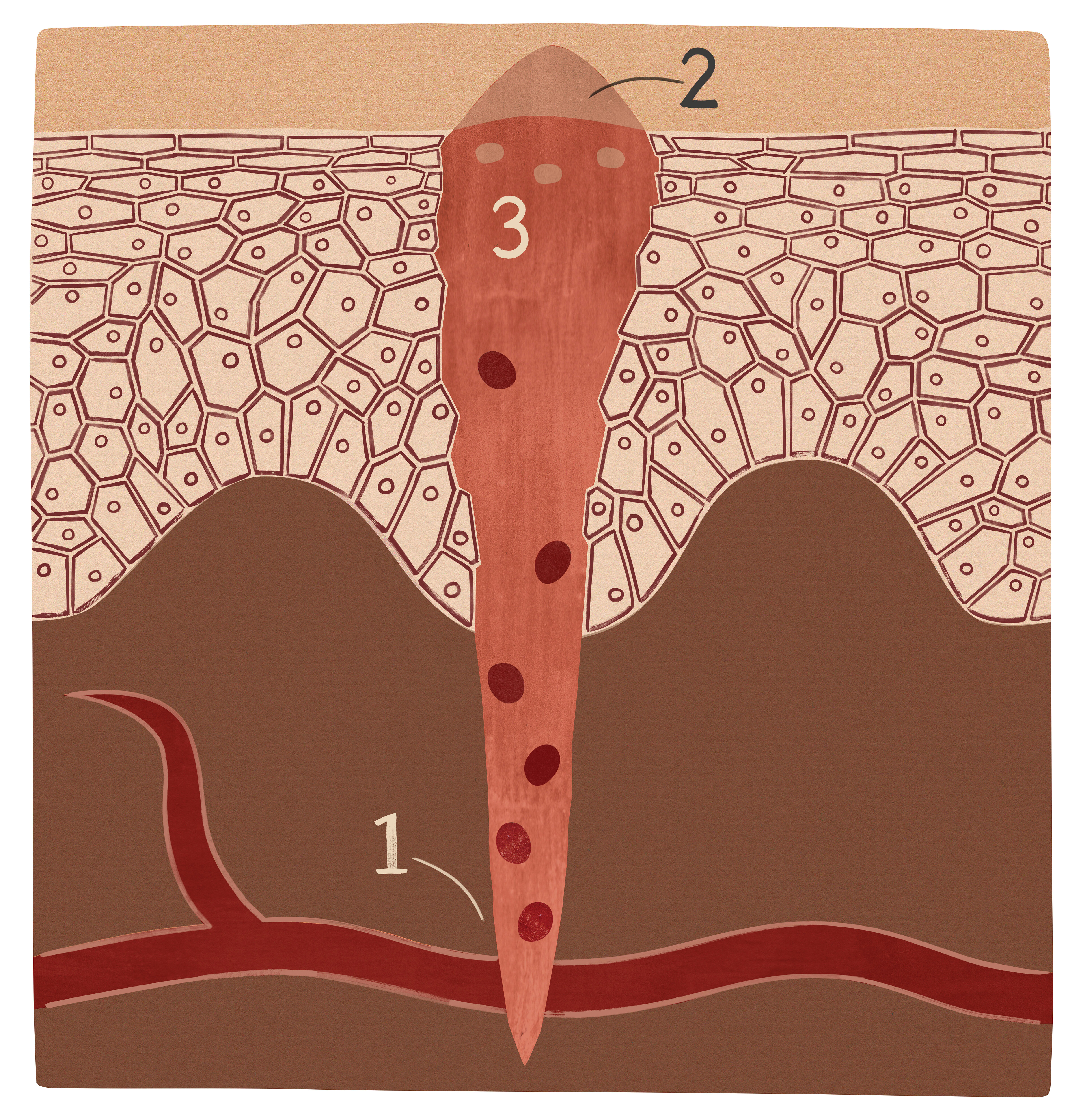 Sår i koagulasjonsfasen Illustrasjonen viser et sår i koagulasjonsfasen