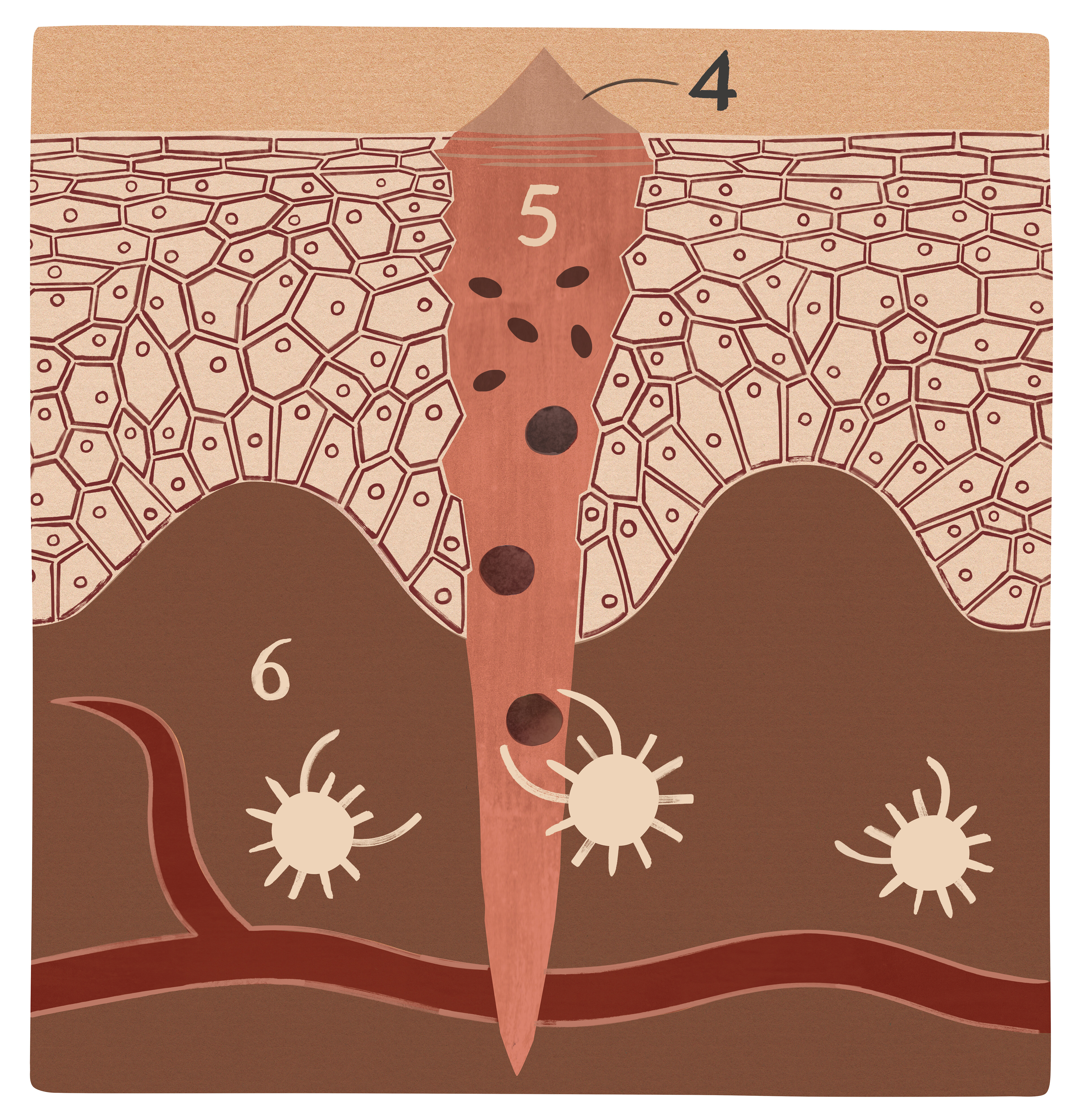 Sår i inflammasjonsfasen Illustrasjonen viser et sår i inflammasjonsfasen