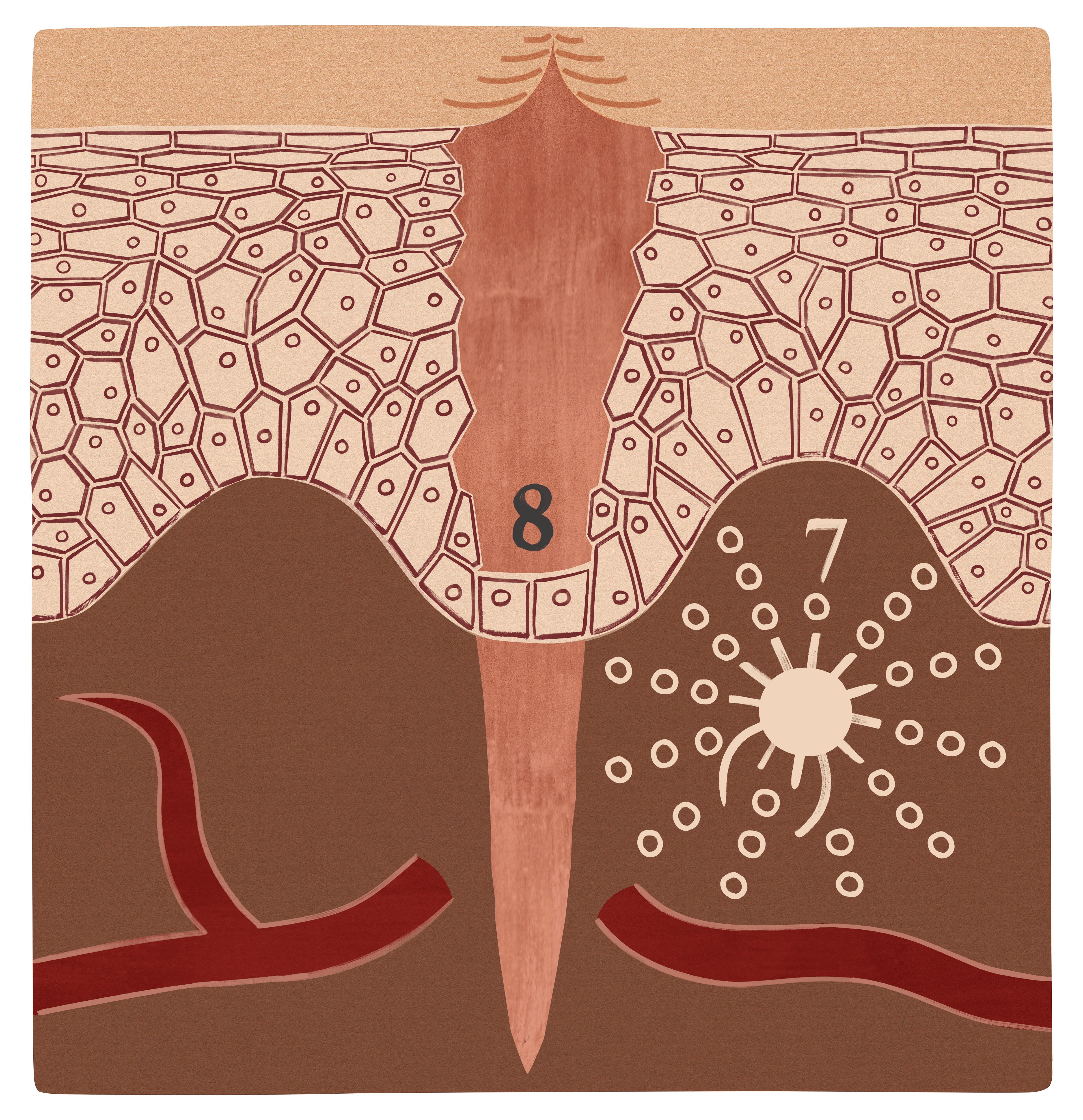 Sår i inflammasjonsfasen Illustrasjonen viser et sår i inflammasjonsfasen