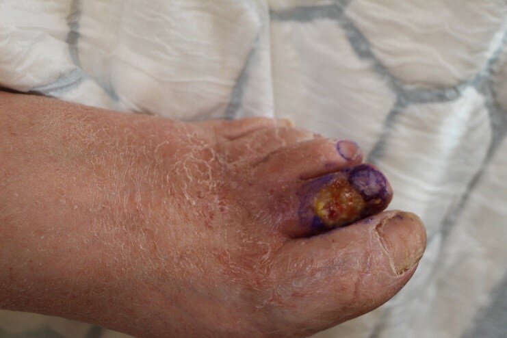 Sår på andre tå Bildet viser en fot med et lite sår på andre tå