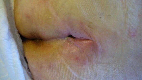 Trykksår som ikke heler Bildet viser et trykksår som ikke heler