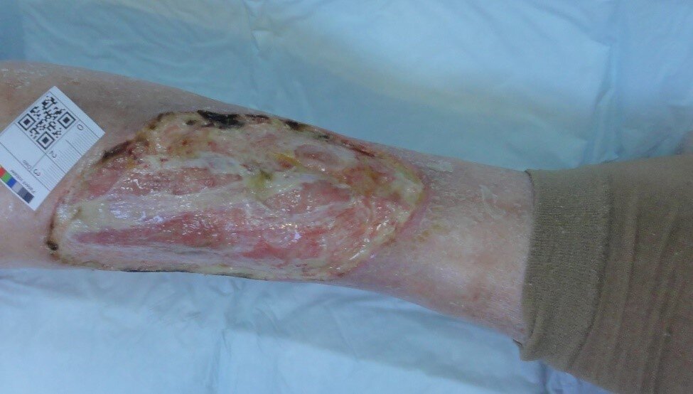 Stort sår på leggen av ukjent årsak Bildet viser et stort sår på leggen av ukjent årsak