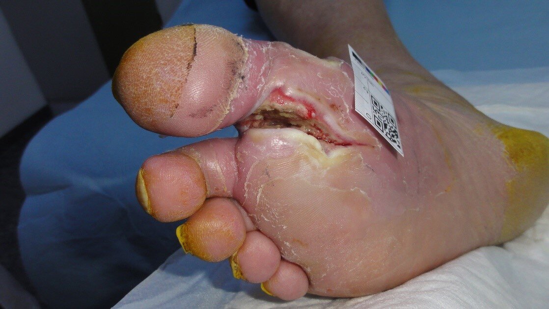 Diabetisk fotsår med infeksjon mellom første og andre tå Bildet viser et diabetisk fotsår med infeksjon mellom første og andre tå
