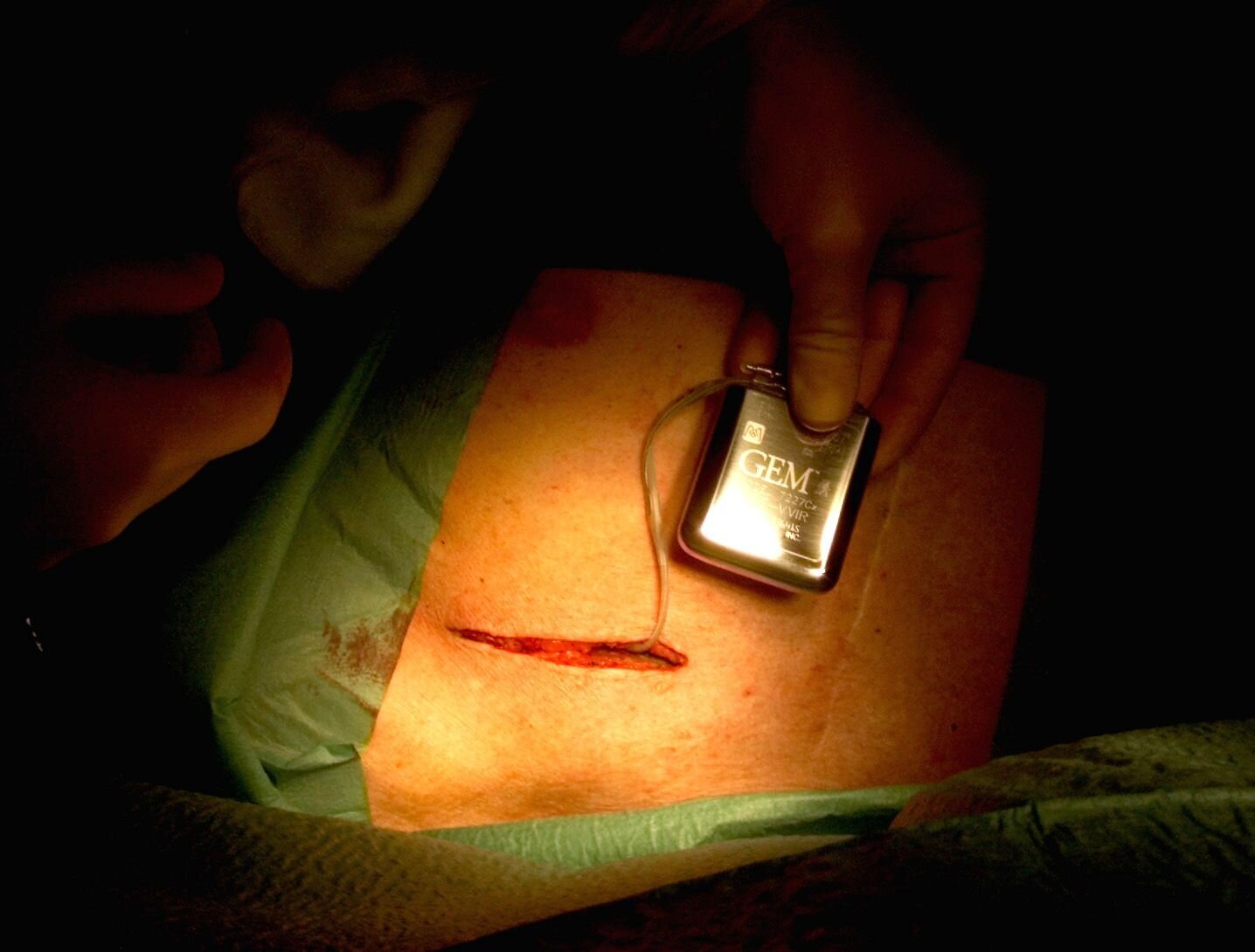 Hjertepasient får operert inn en hjertestarter Bildet viser en pasient som får operert inn en hjertestarter