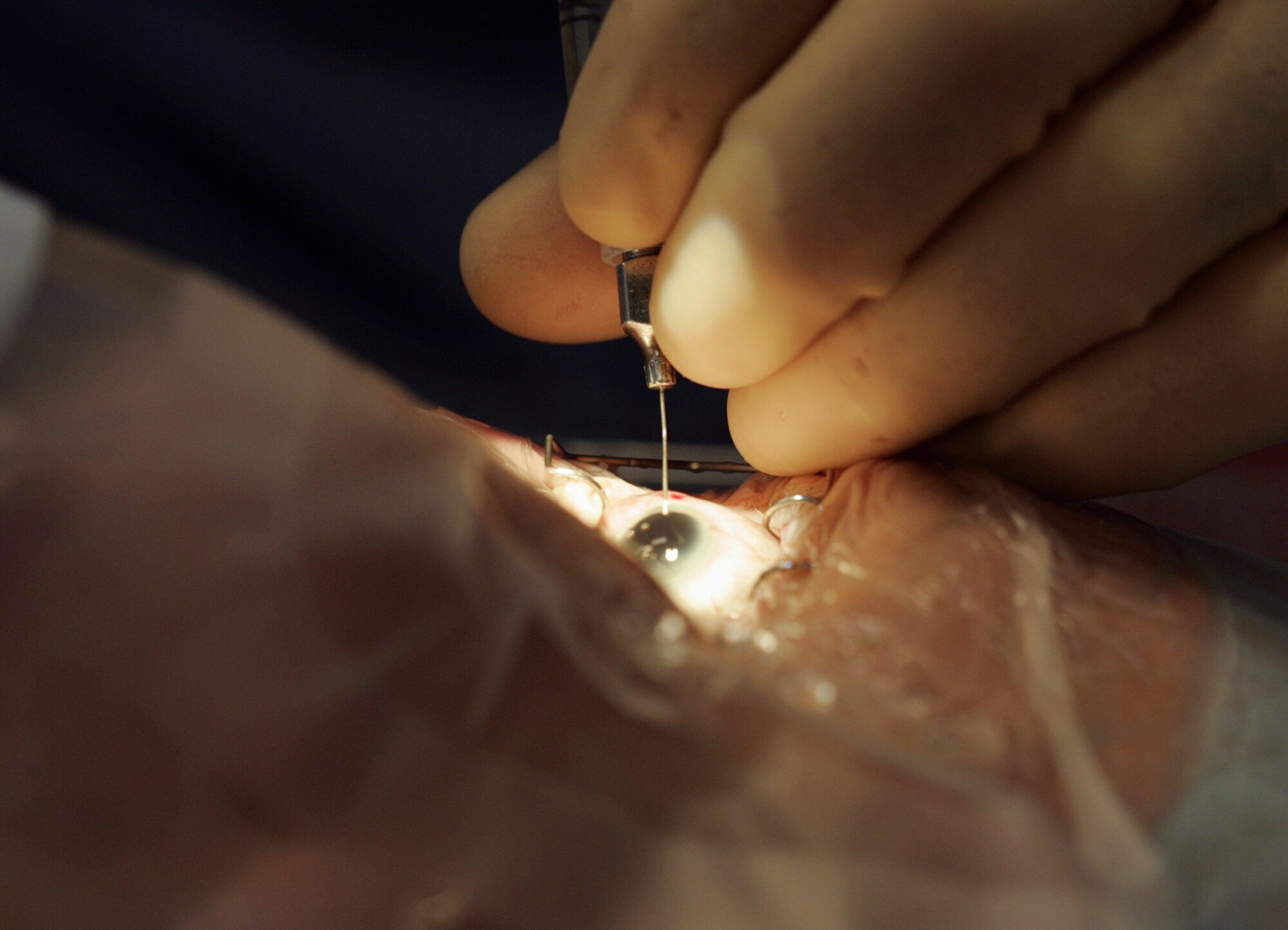 Bildet viser en øyeoperasjon