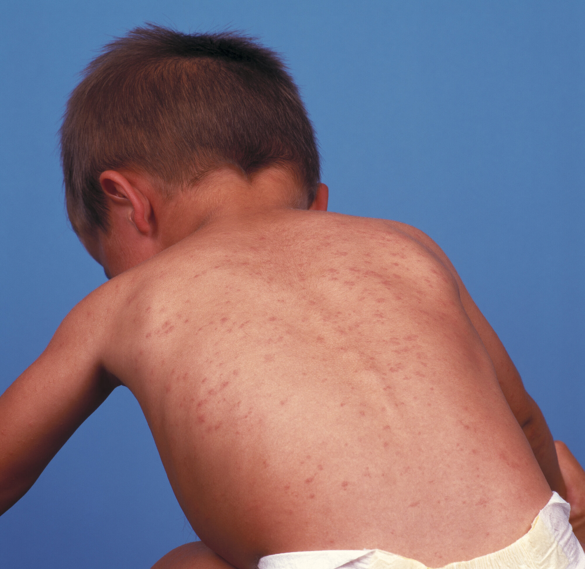 meslinger Bildet viser ryggen på et lite barn som har utslett som skyldes meslinger.