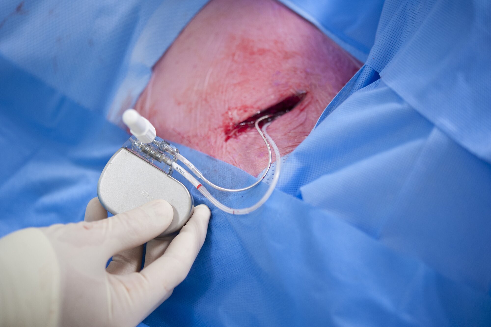 Hjertestarter Hjertestarter blir implementert i kroppen.