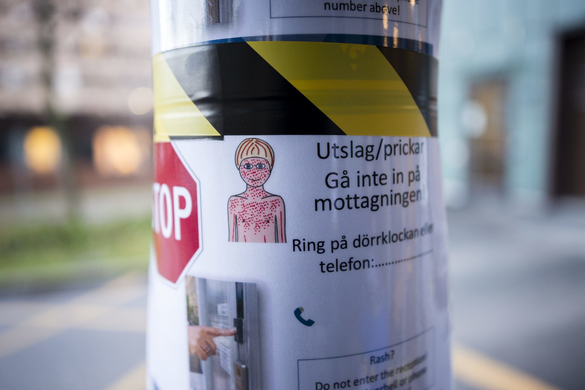 Sahlgrenska Universitetssjukhuset, Göteborg, meslinger Bildet viser en plakat med informasjon om meslinger.