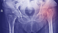 Bildet vier et røntgenbilde av bekkenet.