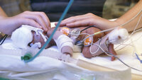 Baby, prematur Bildet viser et ekstremt prematurt barn.