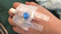 Bildet viser et perifert venekateter på en arm
