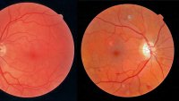 netthinne, diabetes Bildet viser to netthinner.