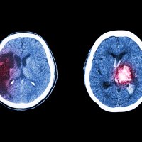 Bildet viser en CT-skanning av hjerneslag på grunn av cerebralt infarkt og blodpropp