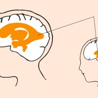 VANNHODE: Hydrocephalus (vannhode) er en tilstand med økt hjernevæske og utvidelse av hjernens naturlige hulrom, ventrikkelsystemet. Kilde: Oslo-universitetssykehus. Illustrasjon: Monica Hilsen