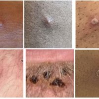 Bildet viser forskjellige stadier av utslett forårsaket av apekopper