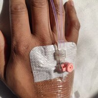 Bildet viser et PVK (perifert venekateter) i hånden